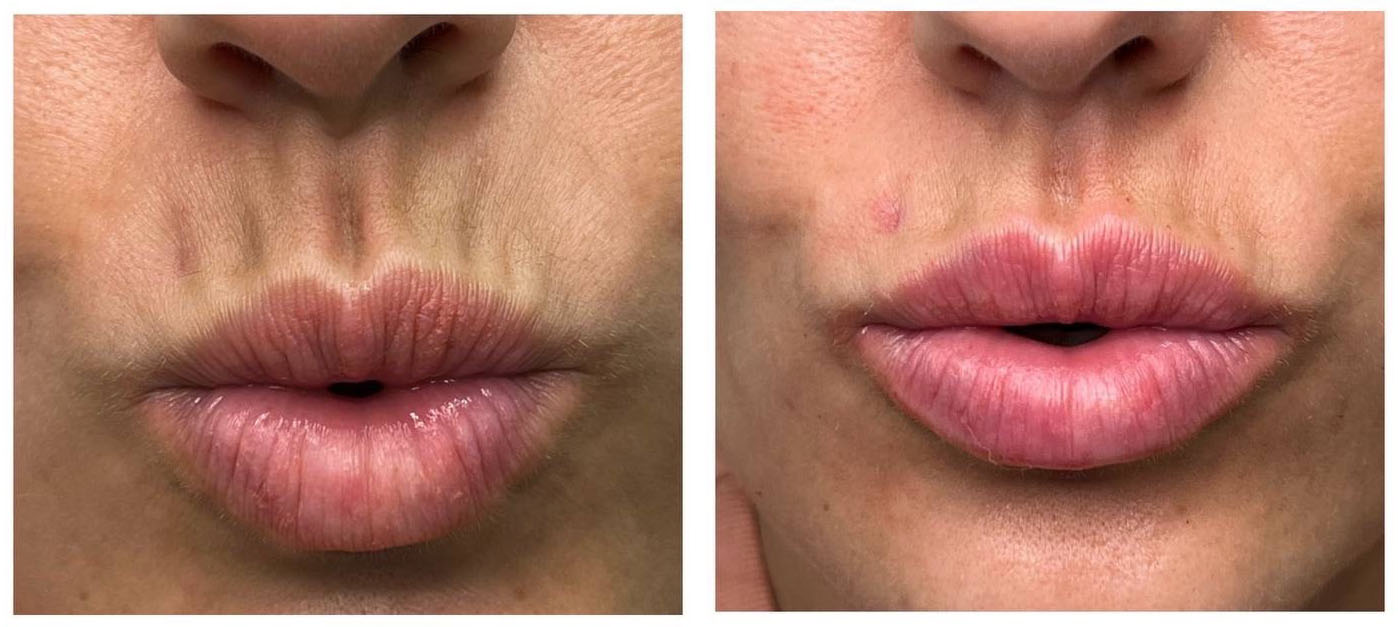 Barcode Wrinkles treatment