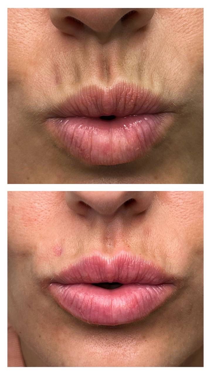 Barcode Wrinkles on the Upper Lip