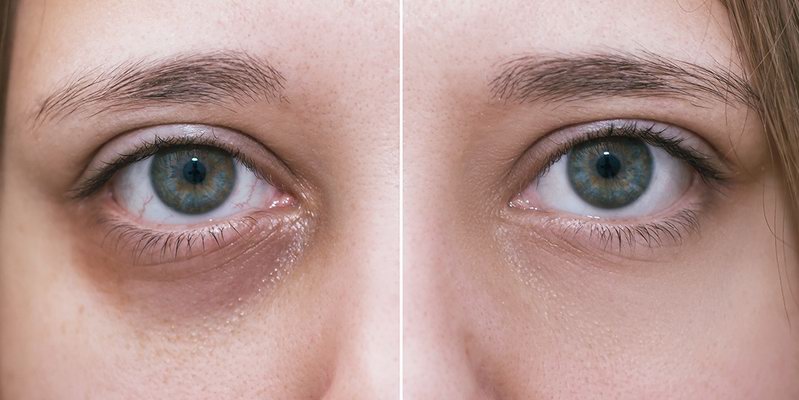 Tratamientos Para Ojeras Y Bolsas Bajo Los Ojos