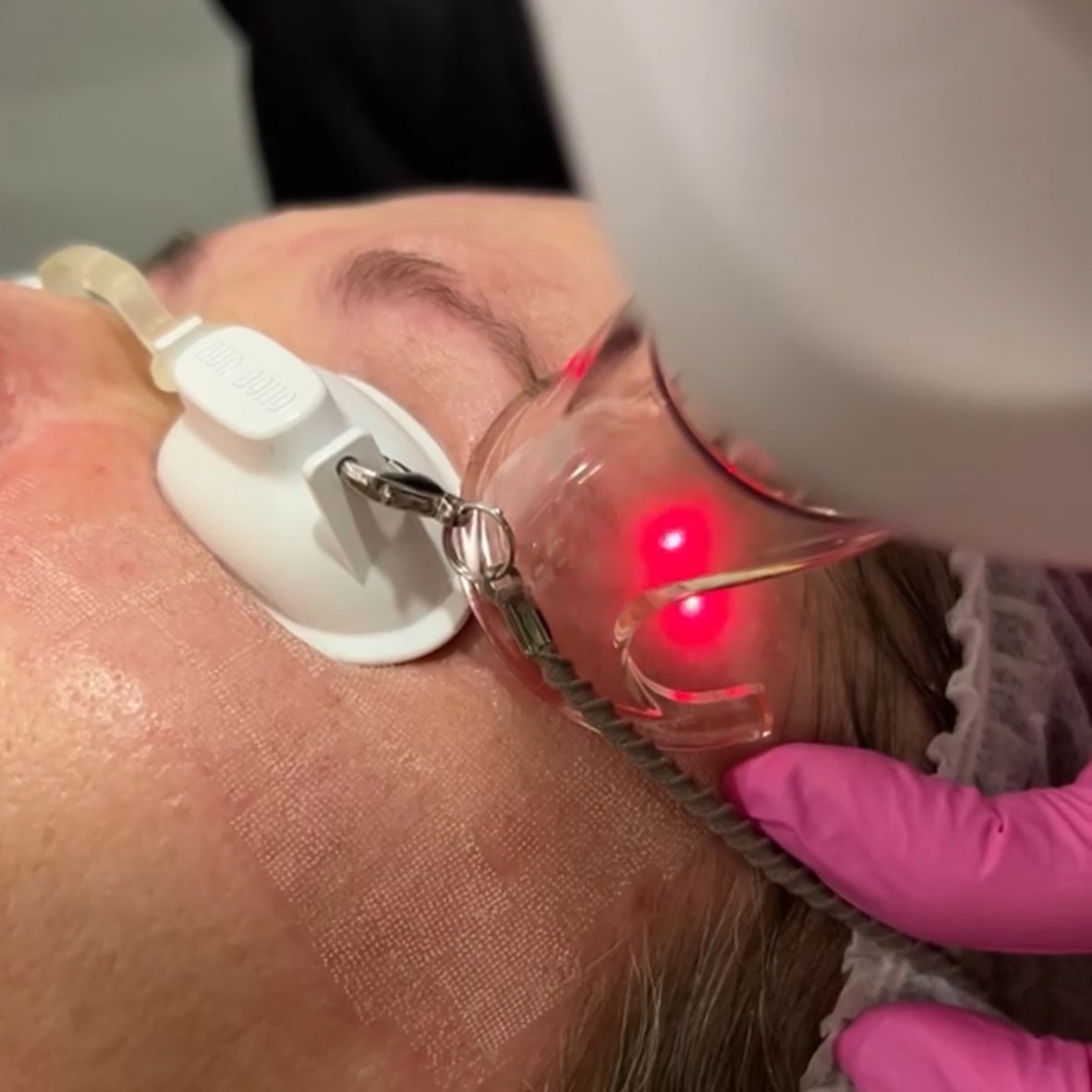 Laser for wrinkles