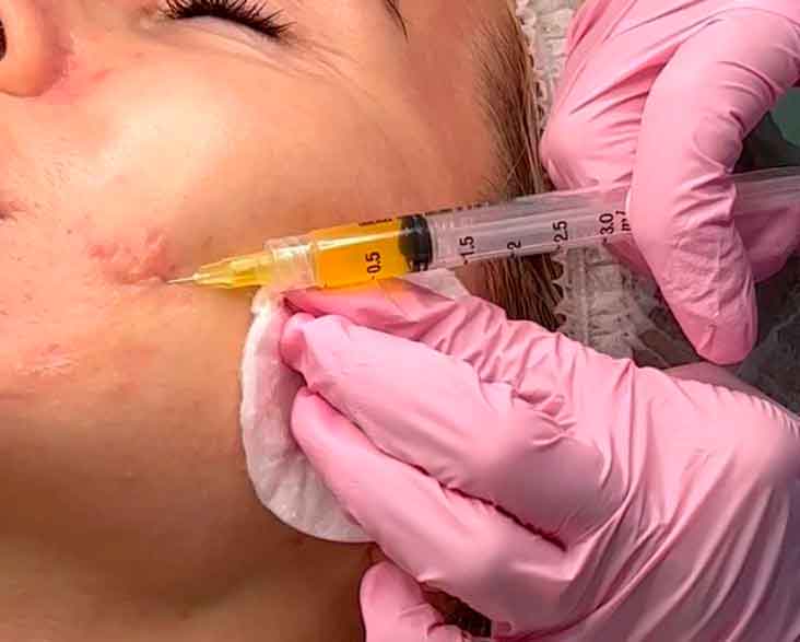 Cosmetología inyectable en Orihuela Costa