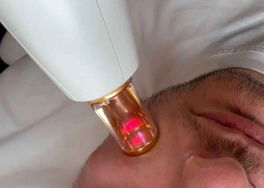 Terapia IPL Lumenis M22