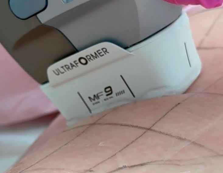 SMAS LIFTING ULTRAFORMER III – la nueva generación de tecnología HIFU
