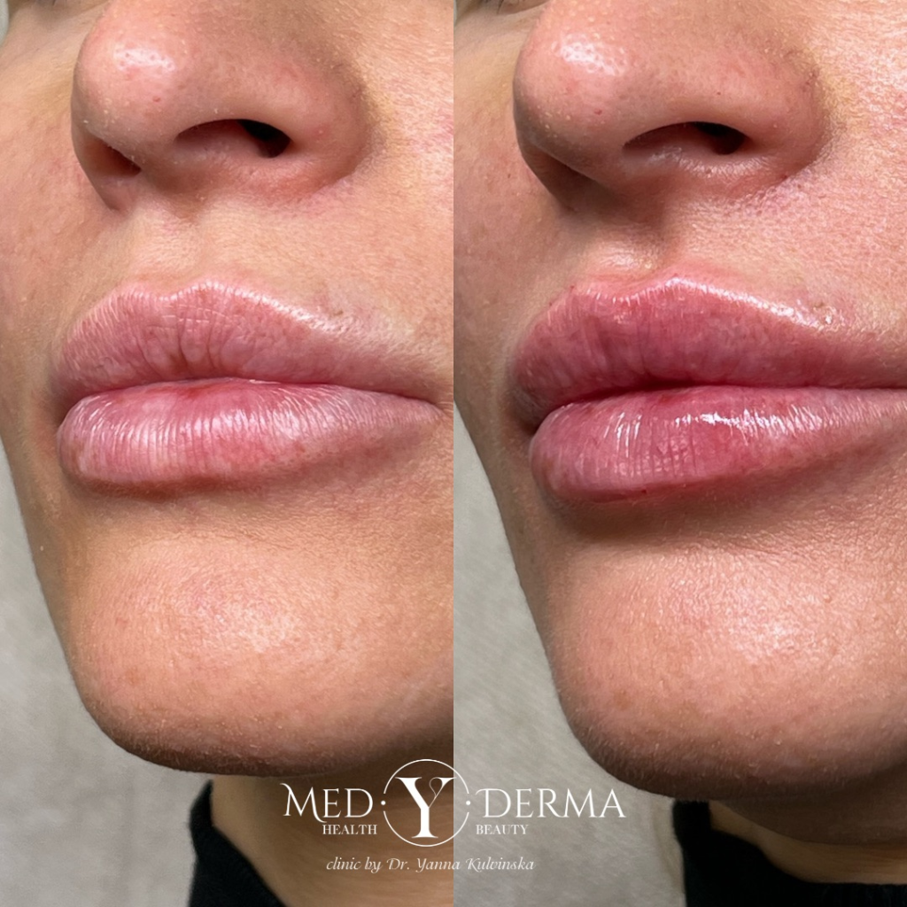 Aumento de Labios