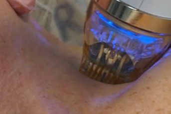 rf lifting micro needling